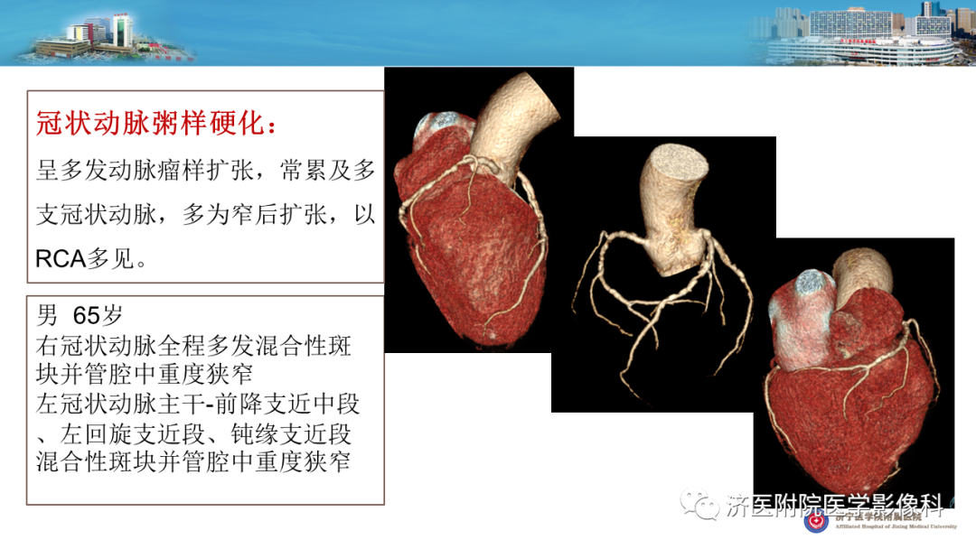 影像PPT - 【PPT】冠状动脉瘘的影像诊断-17