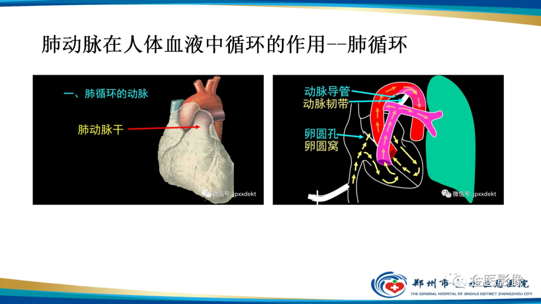 影像PPT - 【PPT】肺动脉栓塞及肺动脉CTA检查技术-6