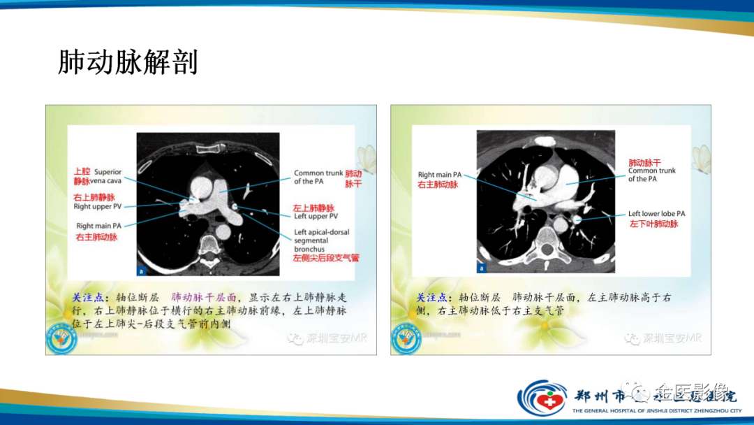 影像PPT - 【PPT】肺动脉栓塞及肺动脉CTA检查技术-9