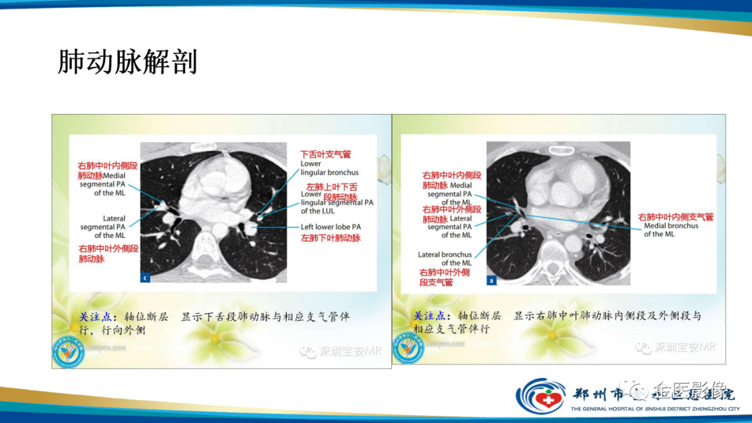 影像PPT - 【PPT】肺动脉栓塞及肺动脉CTA检查技术-10
