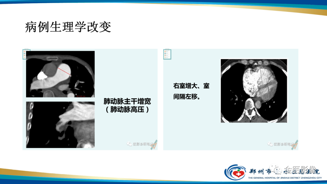 影像PPT - 【PPT】肺动脉栓塞及肺动脉CTA检查技术-14