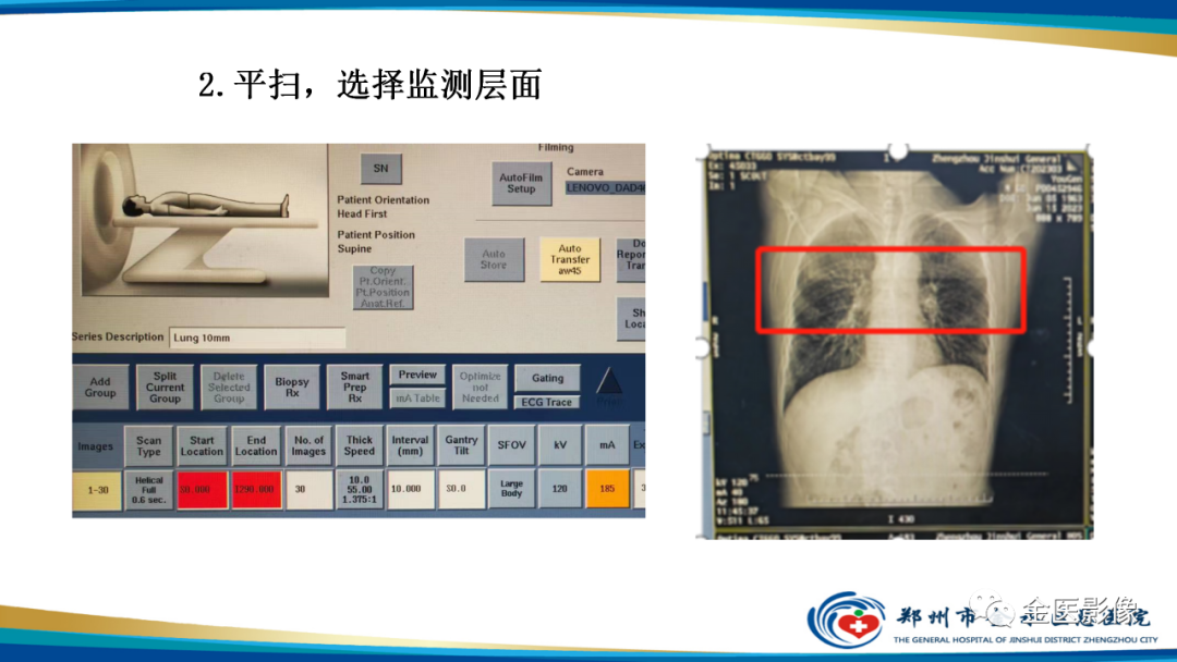 影像PPT - 【PPT】肺动脉栓塞及肺动脉CTA检查技术-30