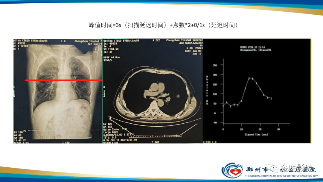 影像PPT - 【PPT】肺动脉栓塞及肺动脉CTA检查技术-32