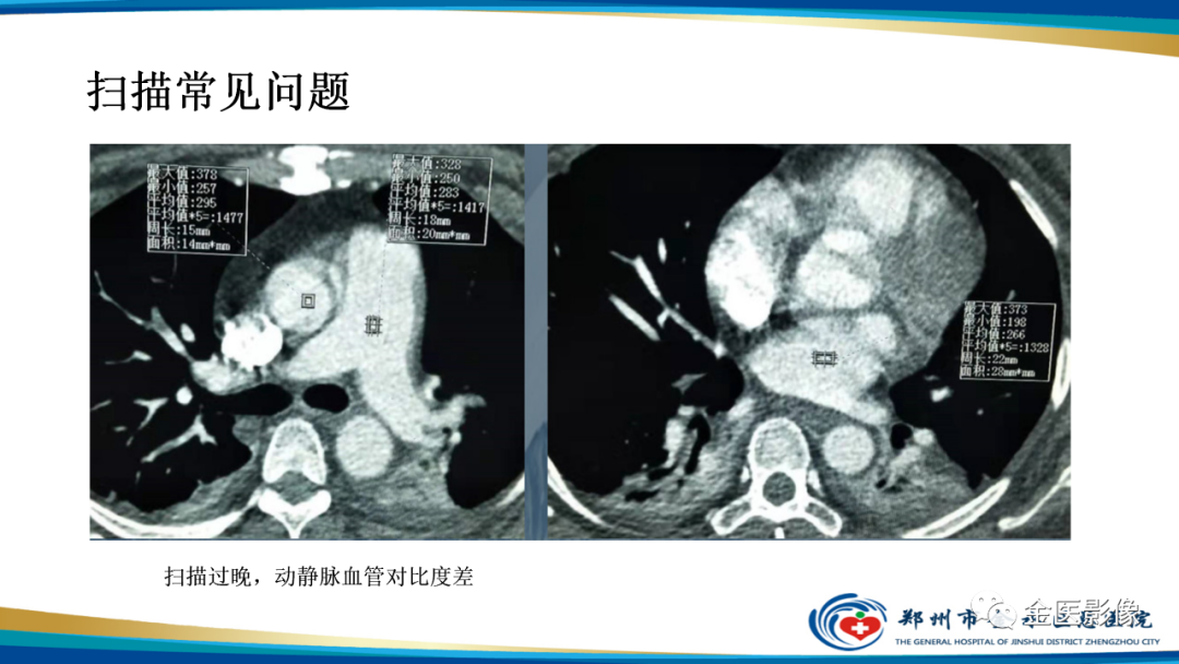 影像PPT - 【PPT】肺动脉栓塞及肺动脉CTA检查技术-42