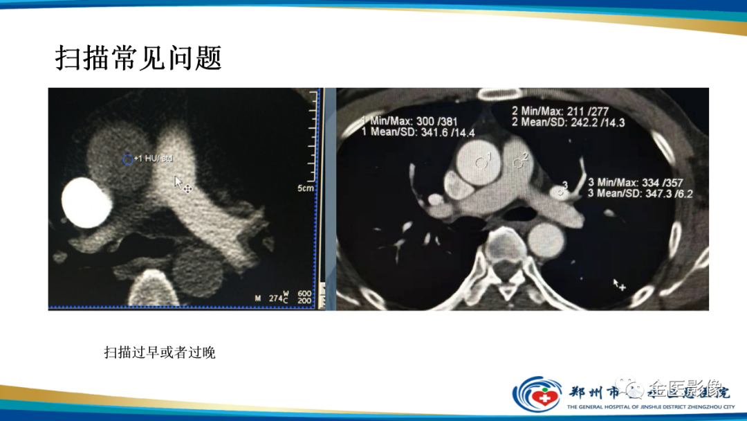 影像PPT - 【PPT】肺动脉栓塞及肺动脉CTA检查技术-43