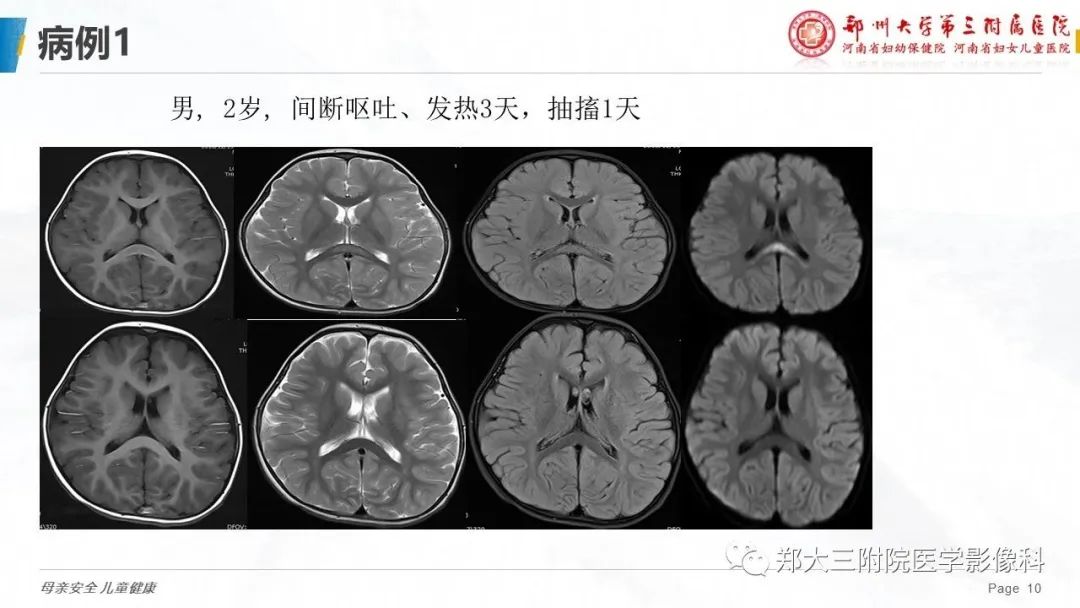影像PPT - 【PPT】可逆性后部脑病综合征的影像诊断-10