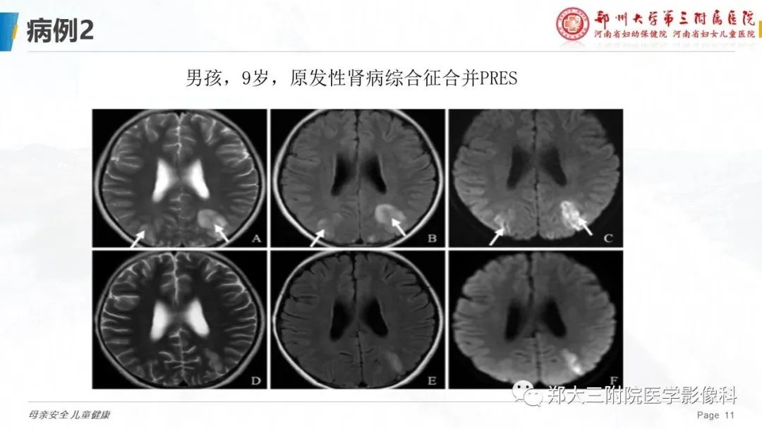 影像PPT - 【PPT】可逆性后部脑病综合征的影像诊断-11