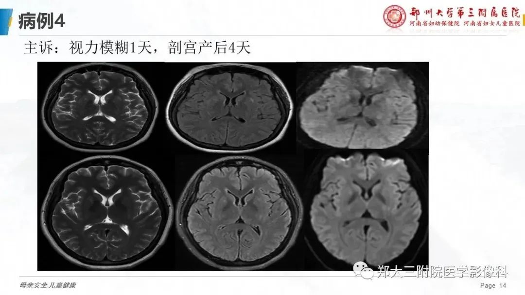 影像PPT - 【PPT】可逆性后部脑病综合征的影像诊断-14