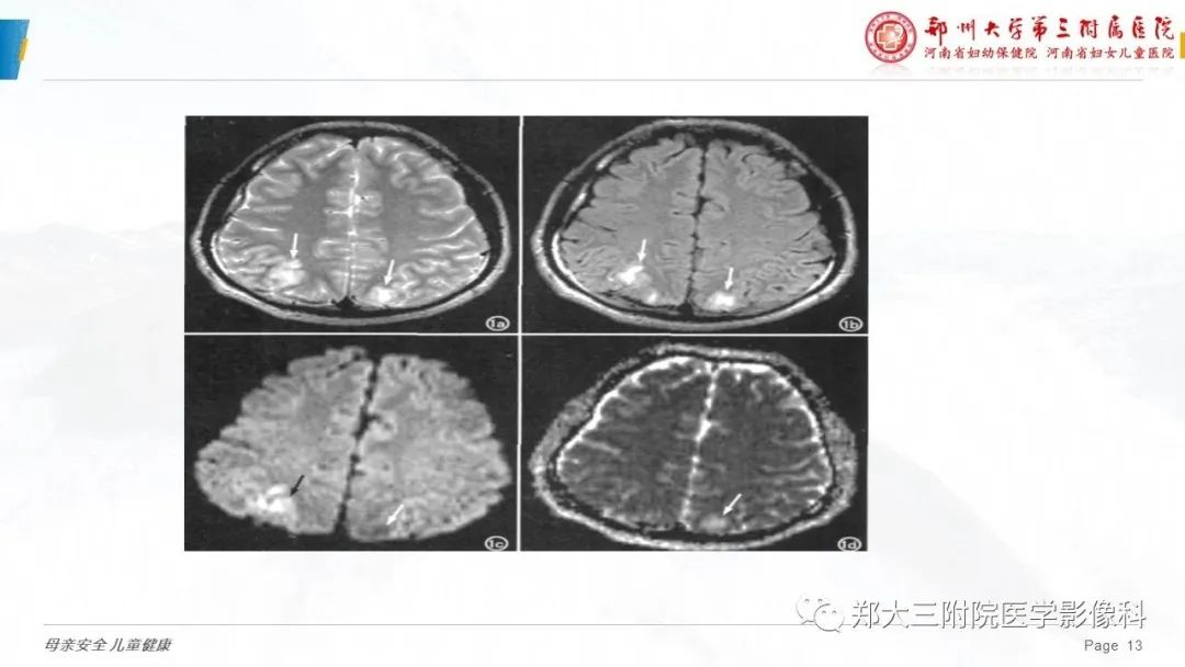 影像PPT - 【PPT】可逆性后部脑病综合征的影像诊断-13
