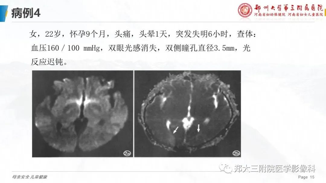 影像PPT - 【PPT】可逆性后部脑病综合征的影像诊断-15