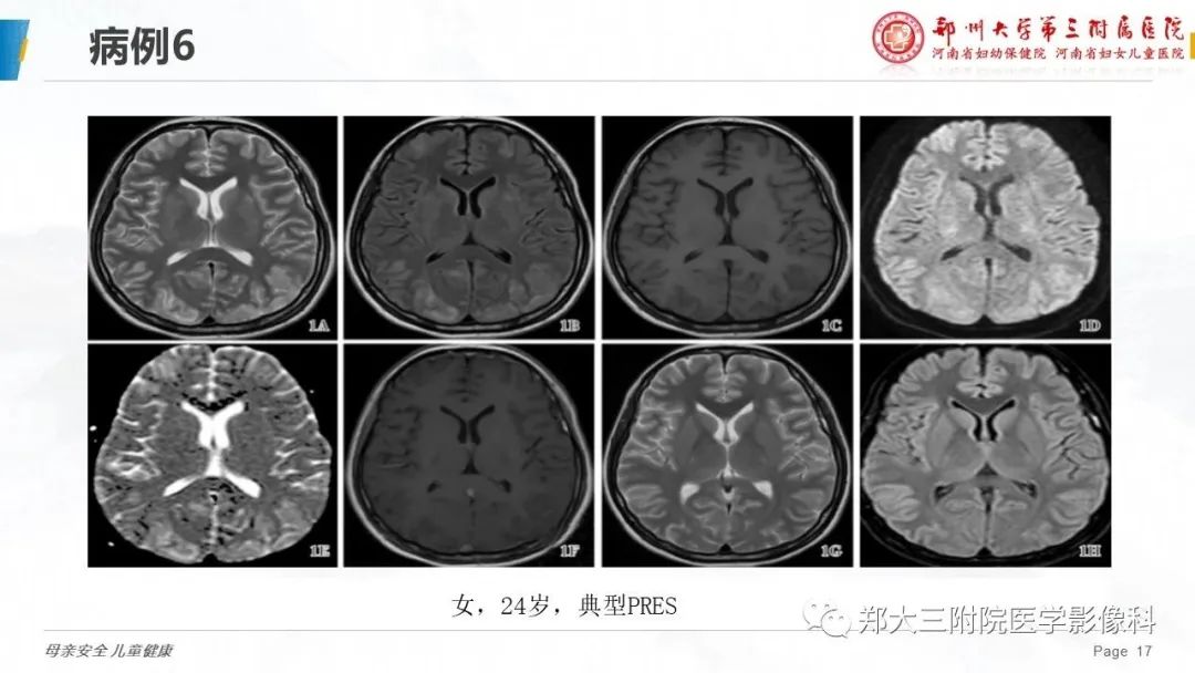 影像PPT - 【PPT】可逆性后部脑病综合征的影像诊断-17