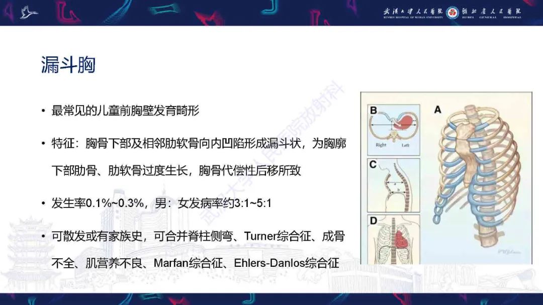 影像PPT - 【PPT】儿童先天性胸廓畸形CT诊断-4