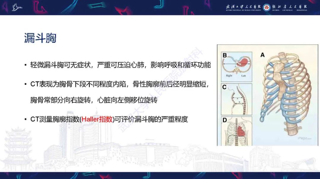 影像PPT - 【PPT】儿童先天性胸廓畸形CT诊断-5