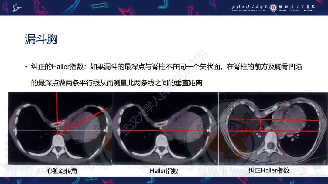 影像PPT - 【PPT】儿童先天性胸廓畸形CT诊断-7
