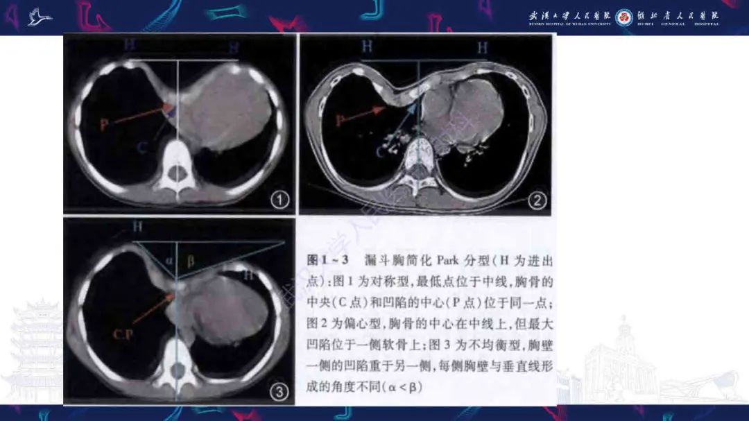 影像PPT - 【PPT】儿童先天性胸廓畸形CT诊断-10