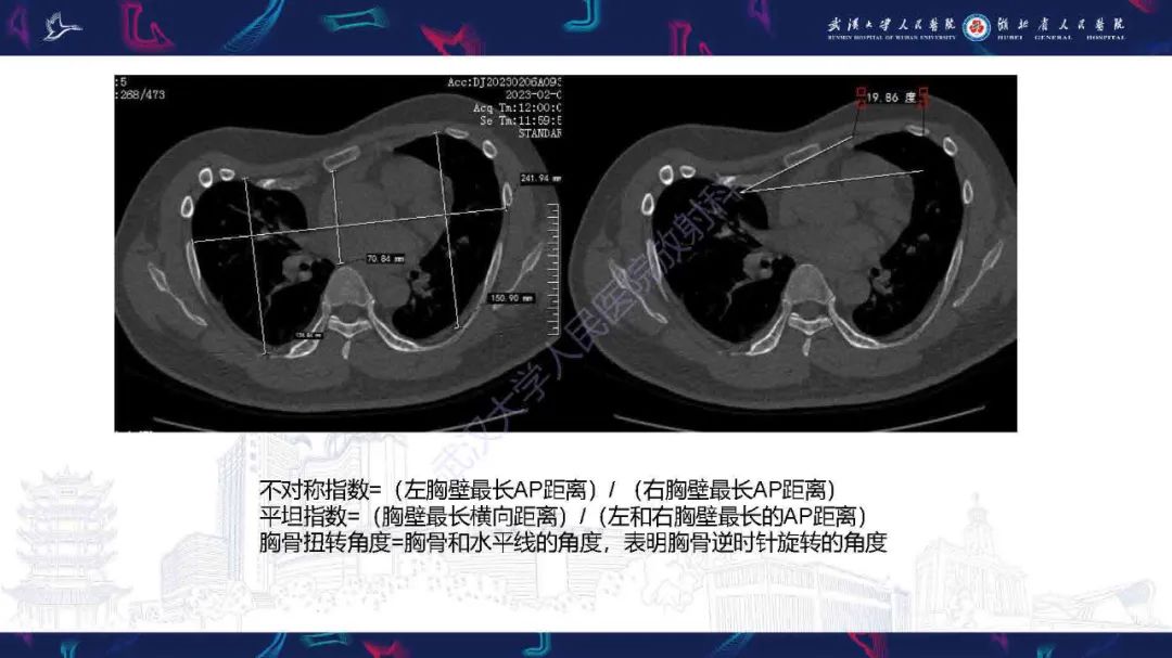 影像PPT - 【PPT】儿童先天性胸廓畸形CT诊断-11