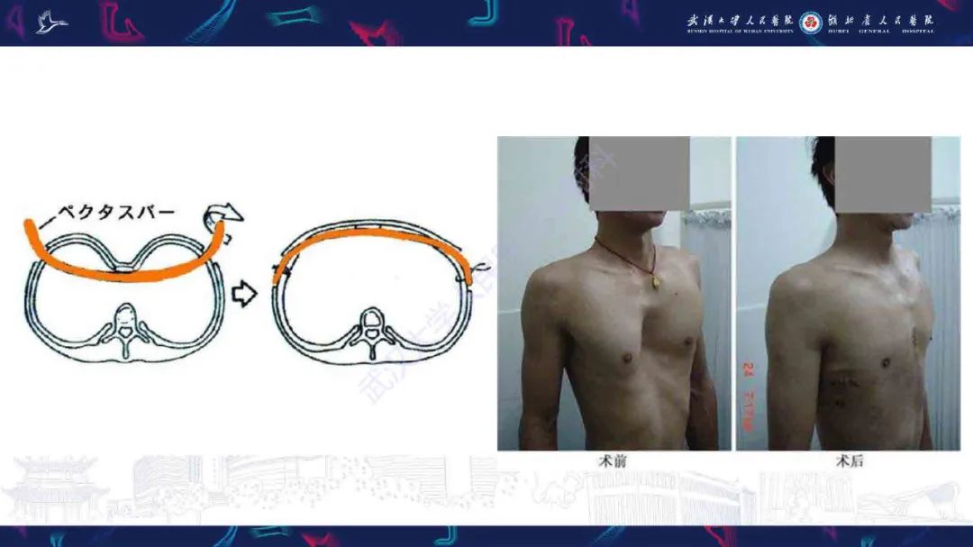 影像PPT - 【PPT】儿童先天性胸廓畸形CT诊断-13