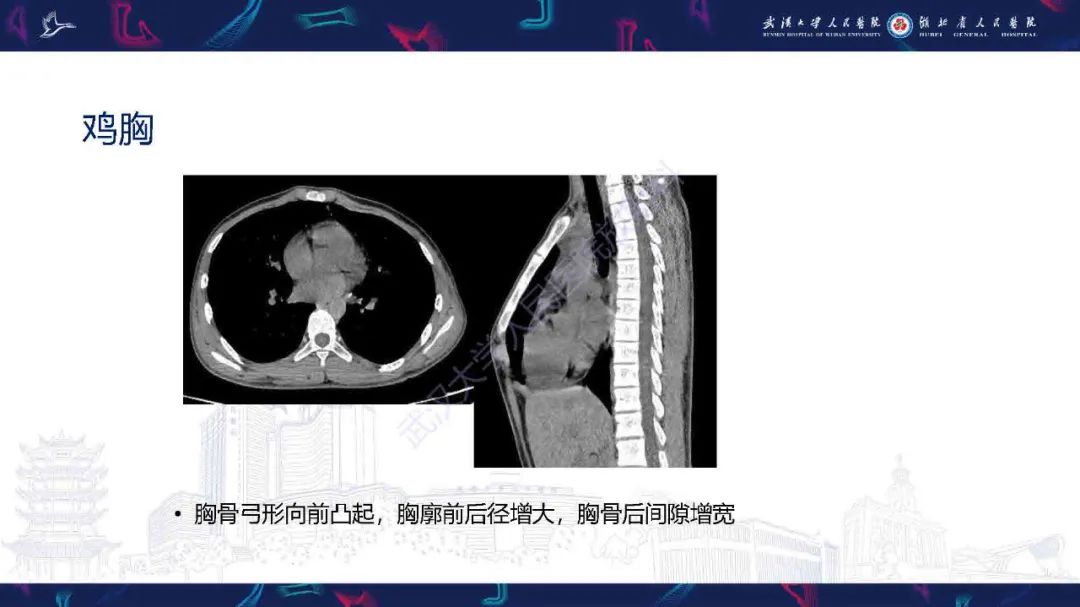 影像PPT - 【PPT】儿童先天性胸廓畸形CT诊断-15