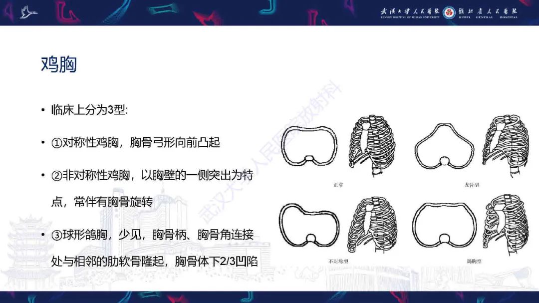 影像PPT - 【PPT】儿童先天性胸廓畸形CT诊断-18