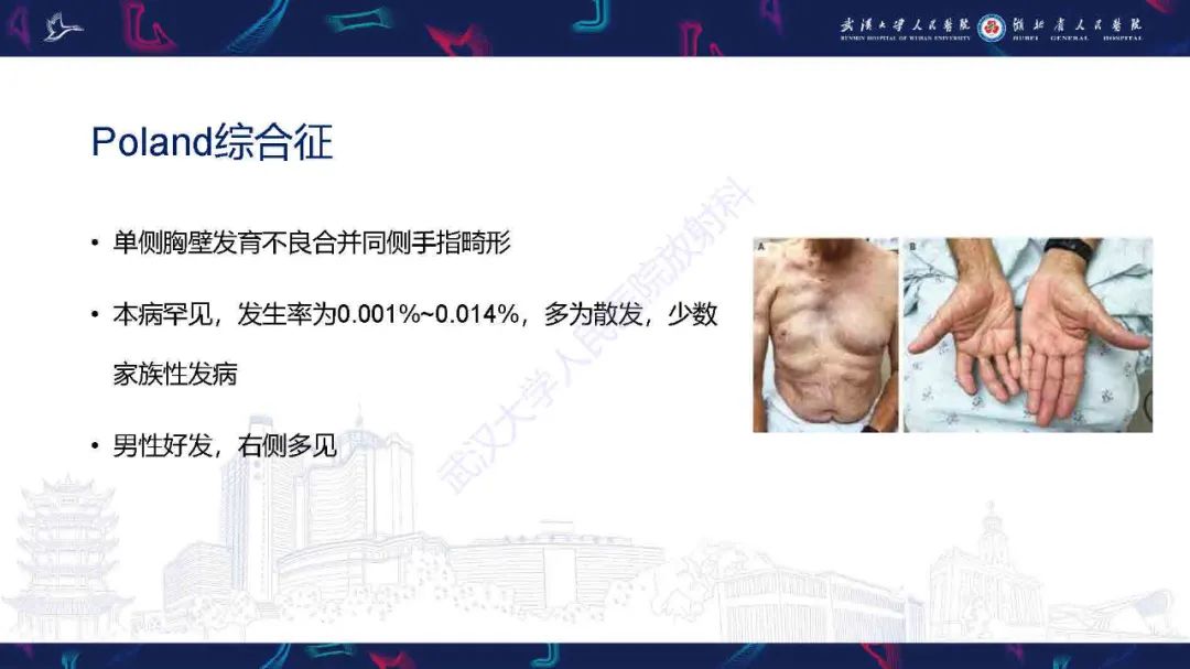 影像PPT - 【PPT】儿童先天性胸廓畸形CT诊断-19