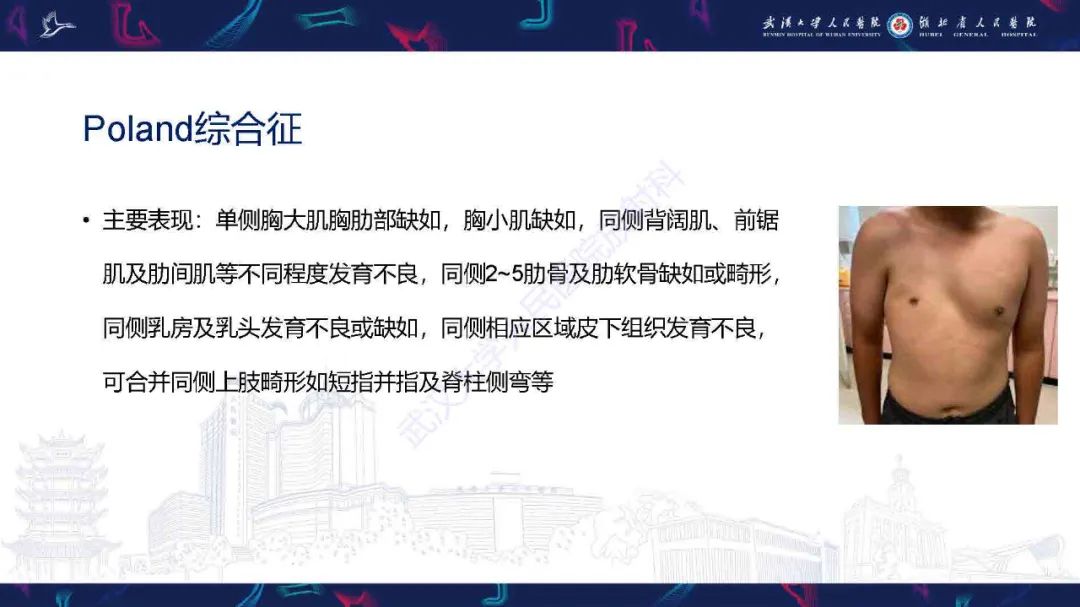 影像PPT - 【PPT】儿童先天性胸廓畸形CT诊断-20