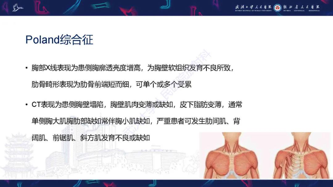 影像PPT - 【PPT】儿童先天性胸廓畸形CT诊断-21