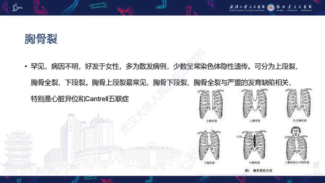 影像PPT - 【PPT】儿童先天性胸廓畸形CT诊断-22