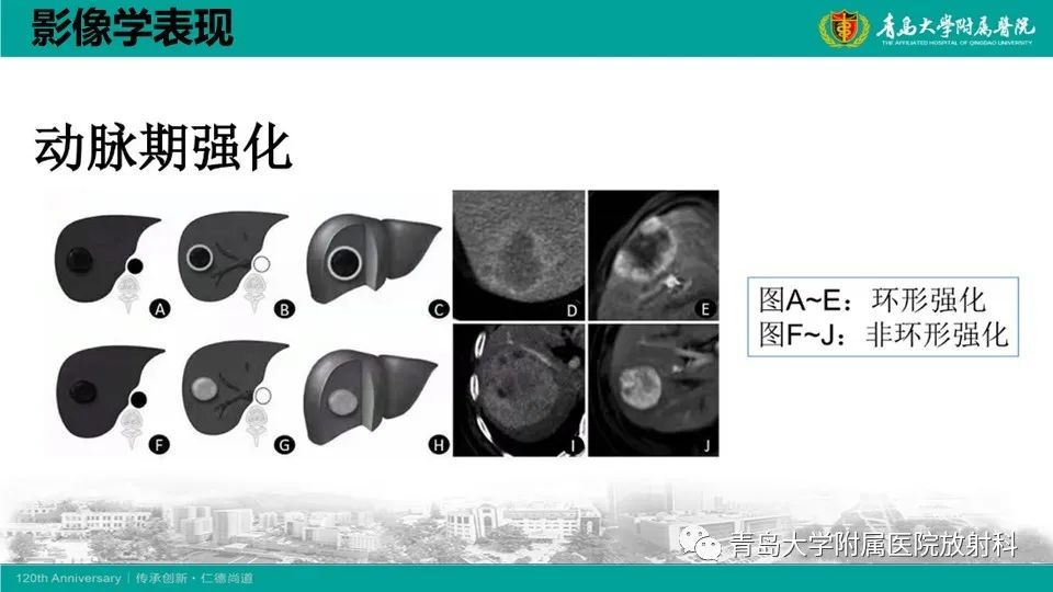 影像PPT - 【PPT】肝细胞癌-15