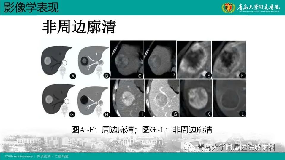 影像PPT - 【PPT】肝细胞癌-17
