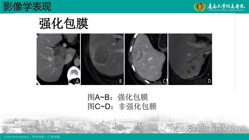 影像PPT - 【PPT】肝细胞癌-19