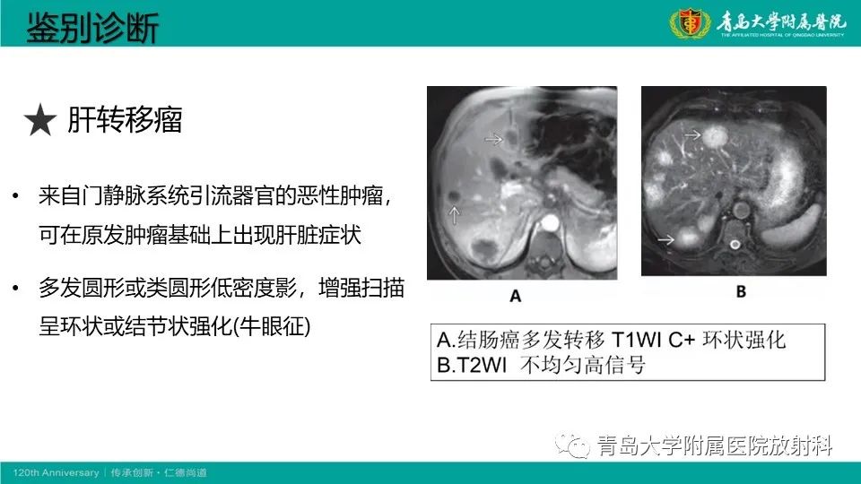 影像PPT - 【PPT】肝细胞癌-25