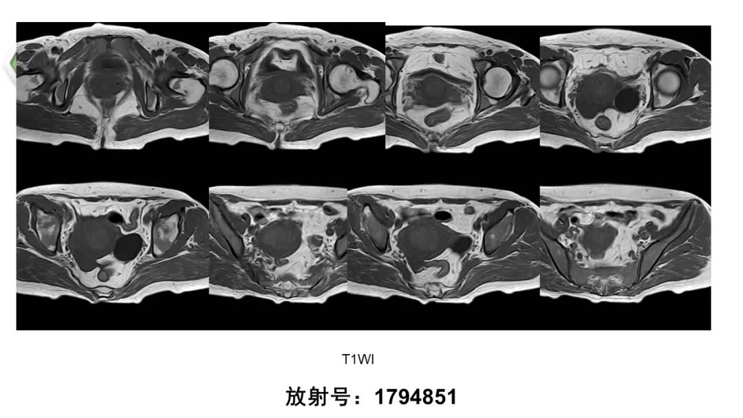 影像PPT - 【病例】子宫内膜癌1例MR影像-4 影像PPT - 【病例】子宫内膜癌1例MR影像-4