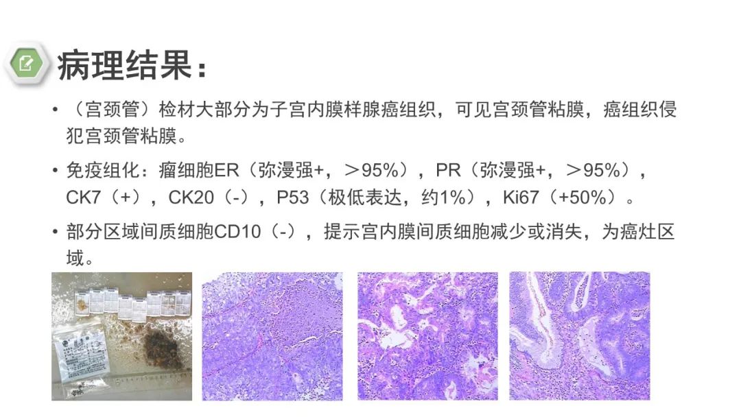 影像PPT - 【病例】子宫内膜癌1例MR影像-11 影像PPT - 【病例】子宫内膜癌1例MR影像-11