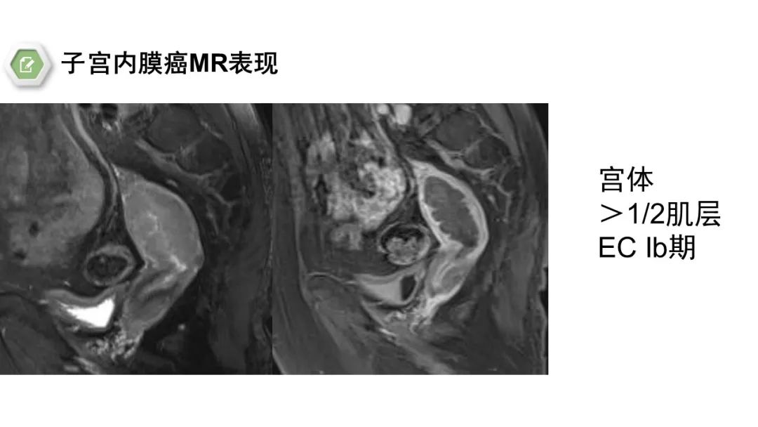 影像PPT - 【病例】子宫内膜癌1例MR影像-17 影像PPT - 【病例】子宫内膜癌1例MR影像-17