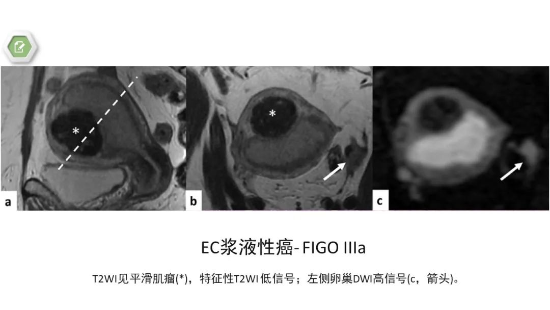 影像PPT - 【病例】子宫内膜癌1例MR影像-21 影像PPT - 【病例】子宫内膜癌1例MR影像-21