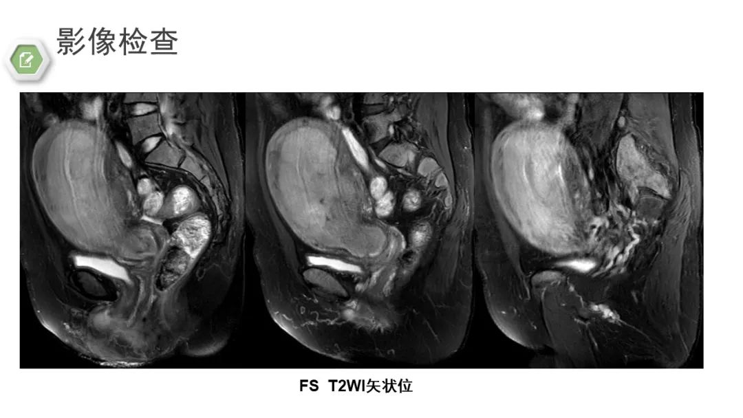 影像PPT - 【病例】子宫内膜癌1例MR影像-24 影像PPT - 【病例】子宫内膜癌1例MR影像-24