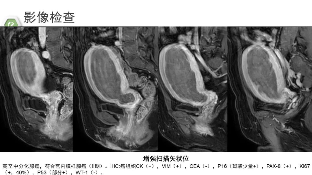 影像PPT - 【病例】子宫内膜癌1例MR影像-27 影像PPT - 【病例】子宫内膜癌1例MR影像-27