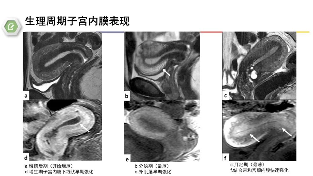影像PPT - 【病例】子宫内膜癌1例MR影像-36 影像PPT - 【病例】子宫内膜癌1例MR影像-36