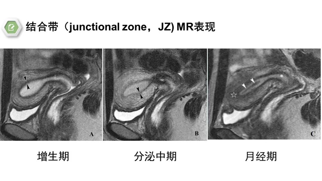 影像PPT - 【病例】子宫内膜癌1例MR影像-39 影像PPT - 【病例】子宫内膜癌1例MR影像-39