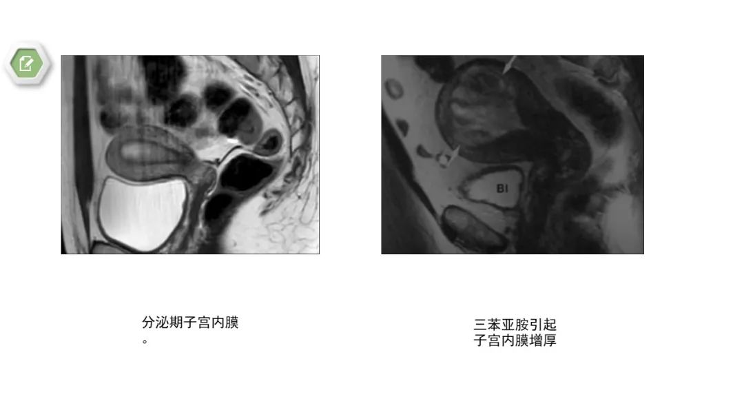 影像PPT - 【病例】子宫内膜癌1例MR影像-41 影像PPT - 【病例】子宫内膜癌1例MR影像-41
