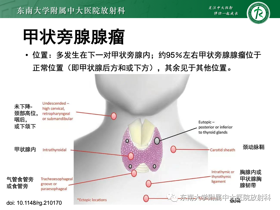 影像PPT - 【PPT】甲状旁腺病变-14