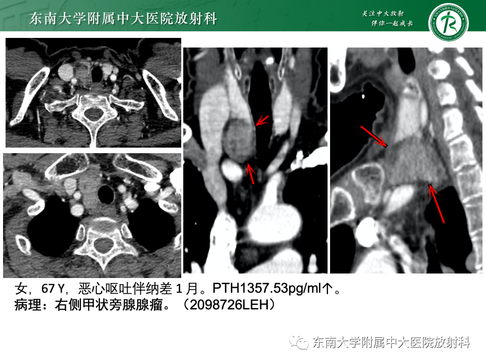 影像PPT - 【PPT】甲状旁腺病变-16