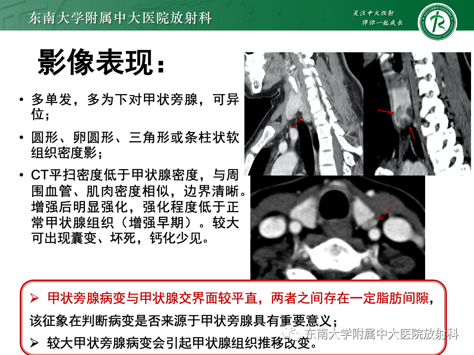 影像PPT - 【PPT】甲状旁腺病变-15