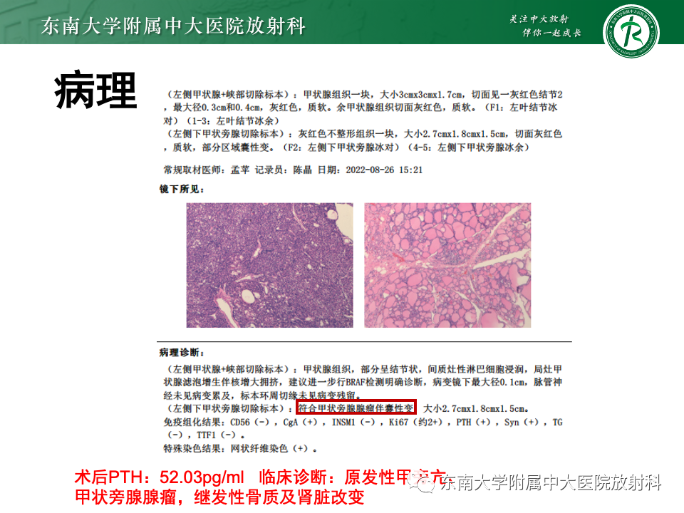 影像PPT - 【PPT】甲状旁腺病变-19