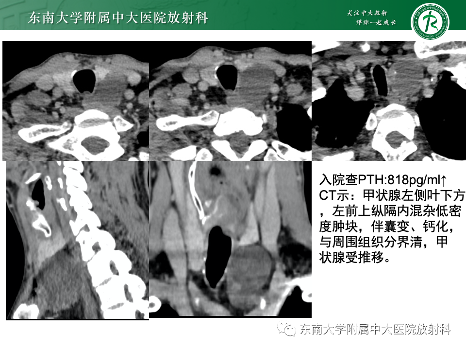 影像PPT - 【PPT】甲状旁腺病变-22