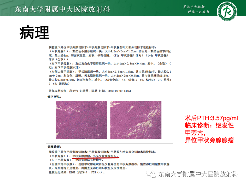 影像PPT - 【PPT】甲状旁腺病变-26