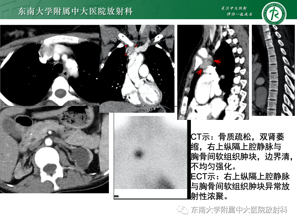 影像PPT - 【PPT】甲状旁腺病变-25