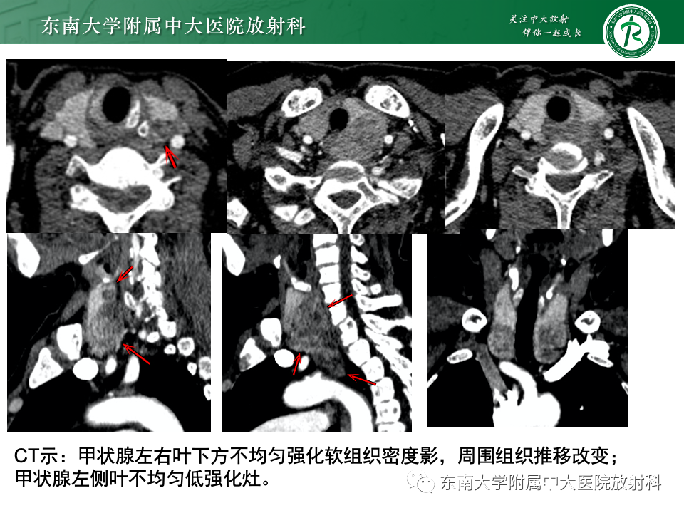 影像PPT - 【PPT】甲状旁腺病变-29
