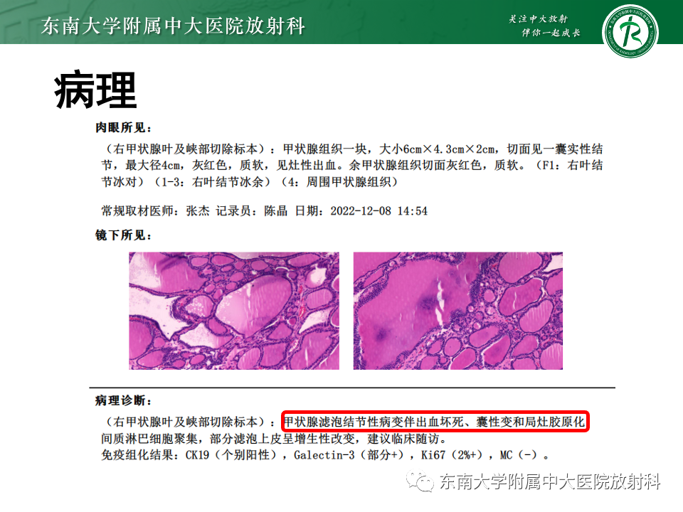 影像PPT - 【PPT】甲状旁腺病变-33