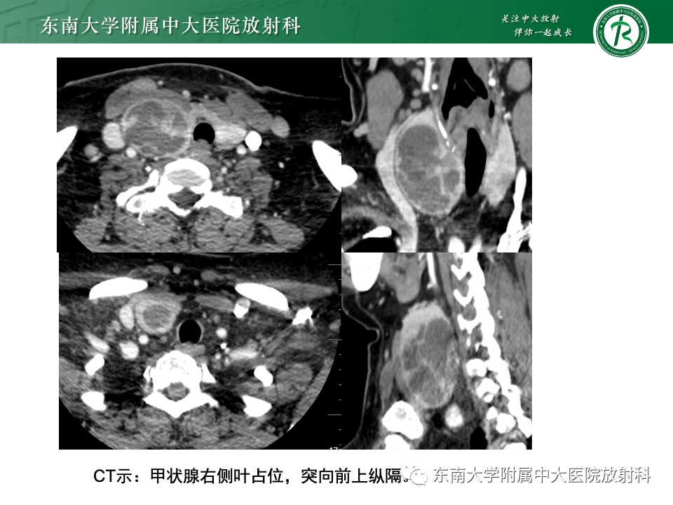 影像PPT - 【PPT】甲状旁腺病变-32